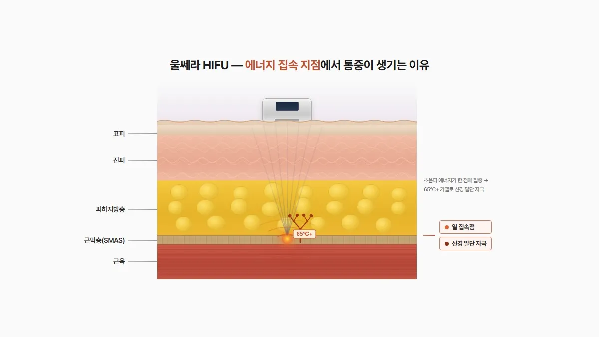 울쎄라 통증, 마취해도 참기 힘든가요?
