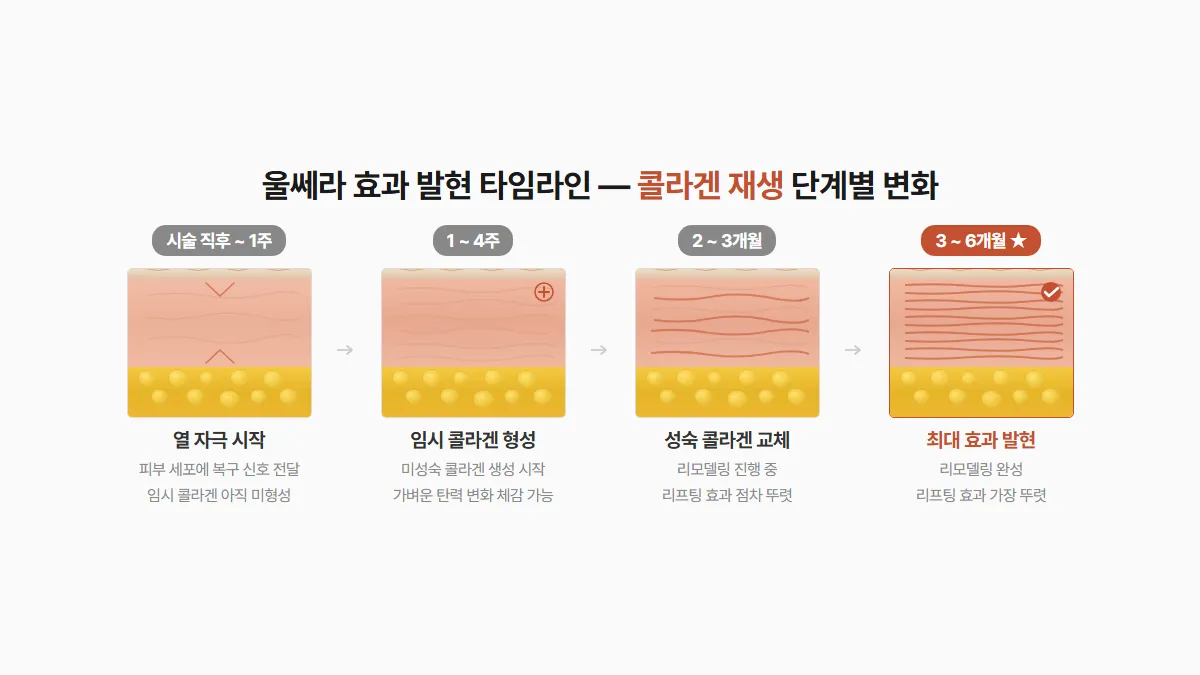 강남 피부과 울쎄라 콜라겐 재생 단계별 효과 타임라인