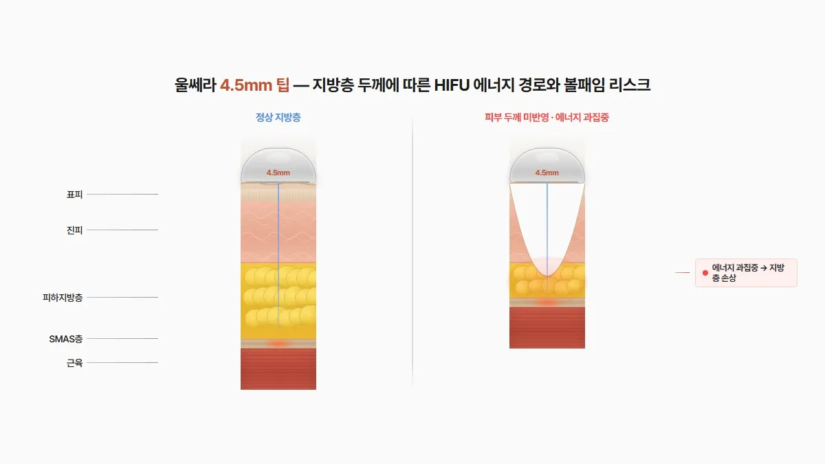 강남 피부과 울쎄라 볼패임 발생 원리 피부 단면도