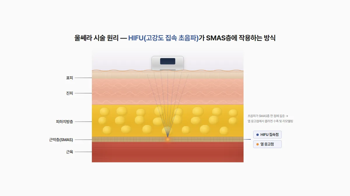 강남 피부과 울쎄라 HIFU 에너지 SMAS층 작동 원리