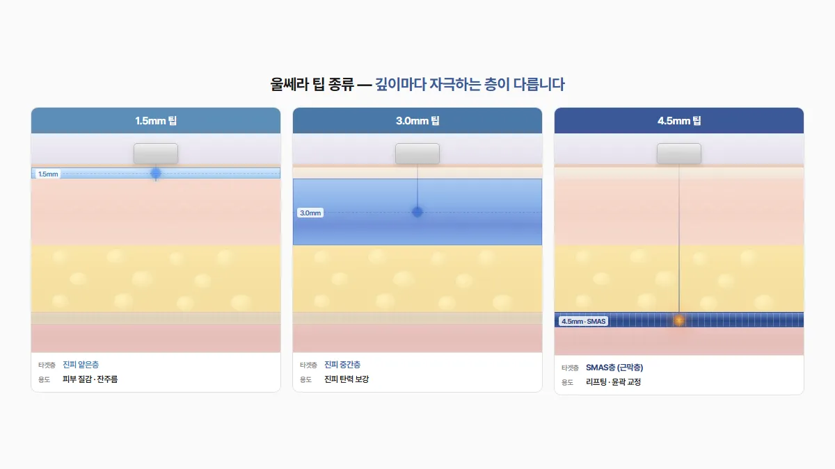 강남 피부과 울쎄라 팁 종류별 타겟 깊이 비교
