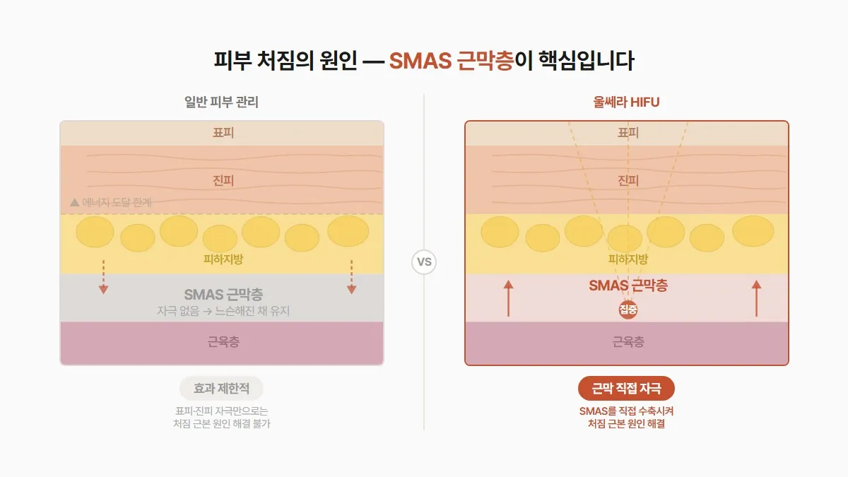 울쎄라 리프팅 원리, 근막층 직접 자극이 처짐에 효과적인 이유