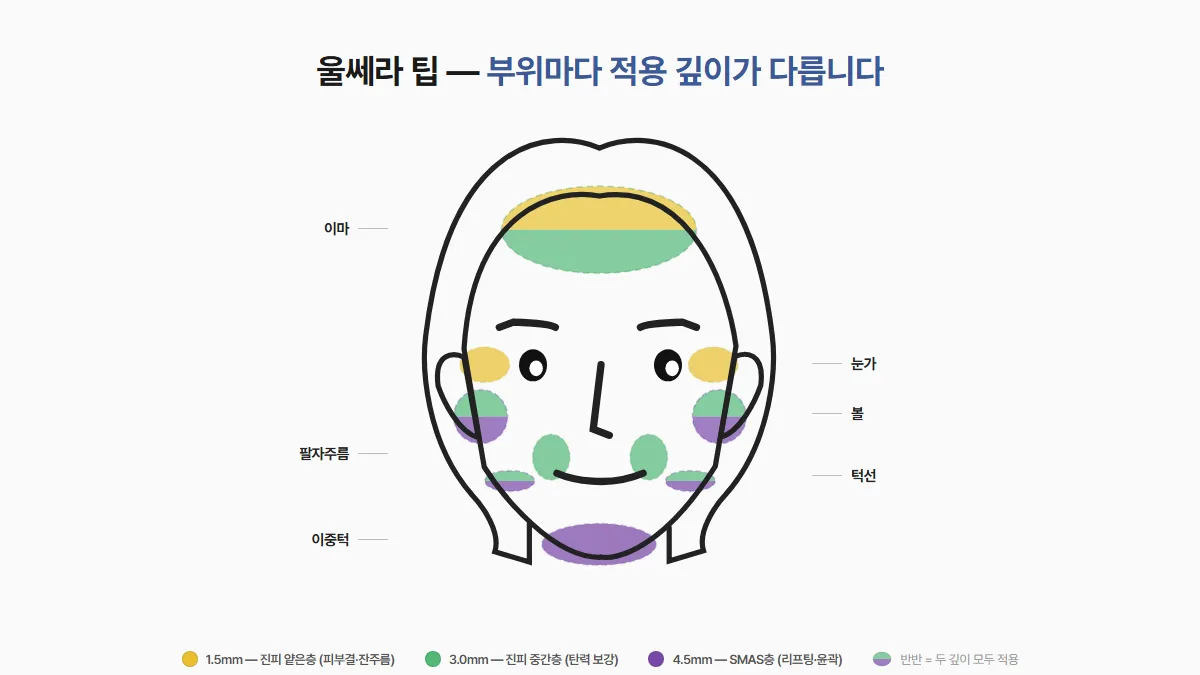 강남 피부과 울쎄라 부위별 팁 적용 가이드