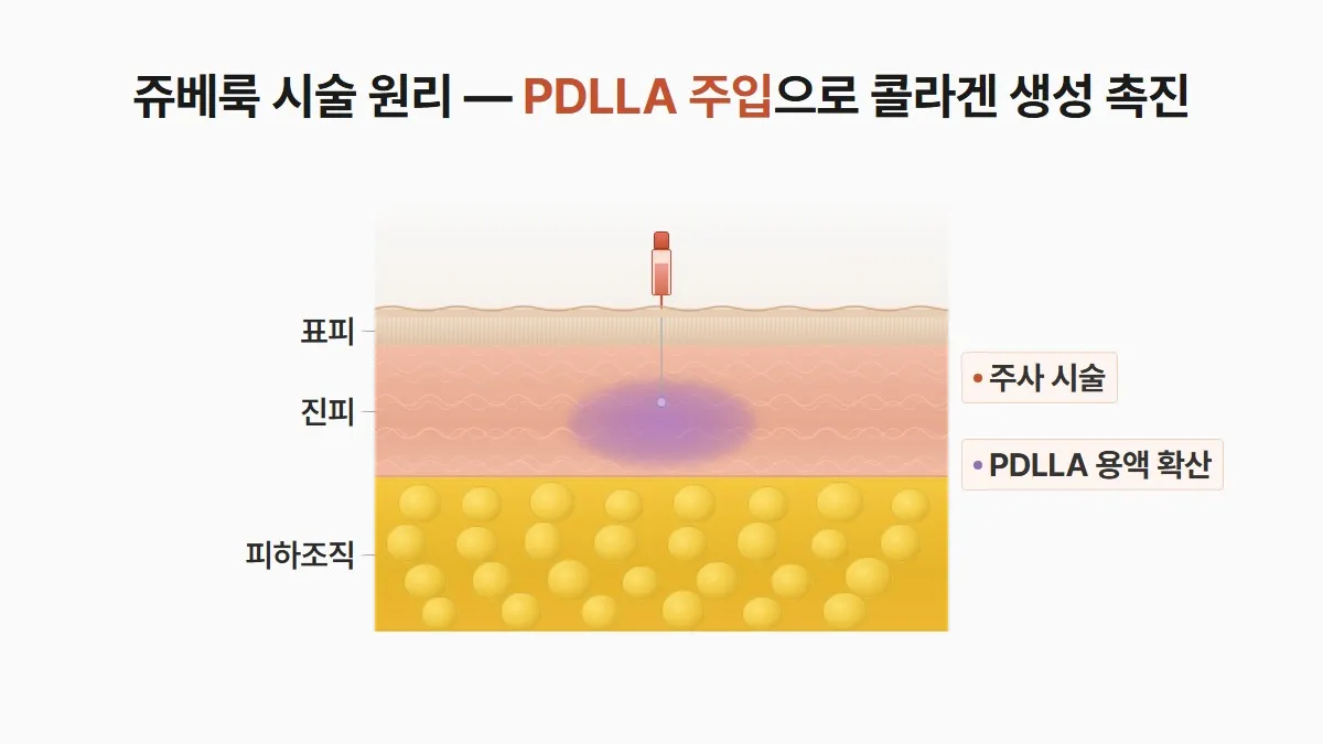 강남 피부과 쥬베룩 PDLLA 주입 피부층 단면도