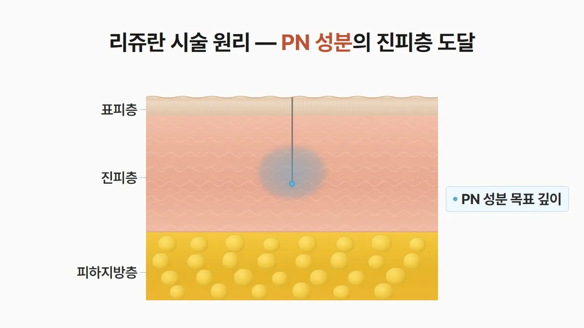 강남 피부과 리쥬란 주입 깊이 원리