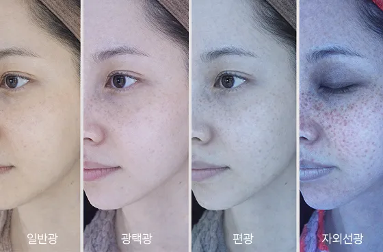 페슈의원 3D 메타뷰 광학 진단 — 4채널 광원(일반광·광택광·편광·자외선광)으로 피부 표면·색소·자외선 손상을 정밀 측정한 결과 화면