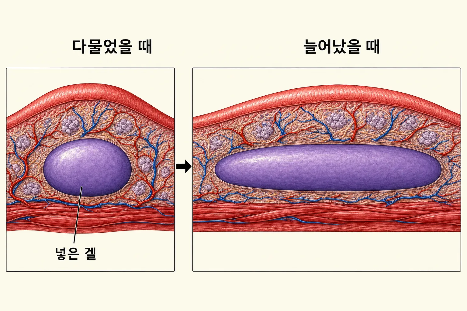 입술을 입꼬리에서 입꼬리까지 길게 자른 단면을 두 장면으로 나란히 그린 그림 — 왼쪽은 입을 다문 상태로 조직 한가운데에 겔이 둥근 덩어리로 자리 잡은 모습, 오른쪽은 입술이 늘어난 상태로 조직이 옆으로 길어지면서 그 안의 겔도 끊기지 않고 같은 방향으로 길게 늘어난 모습