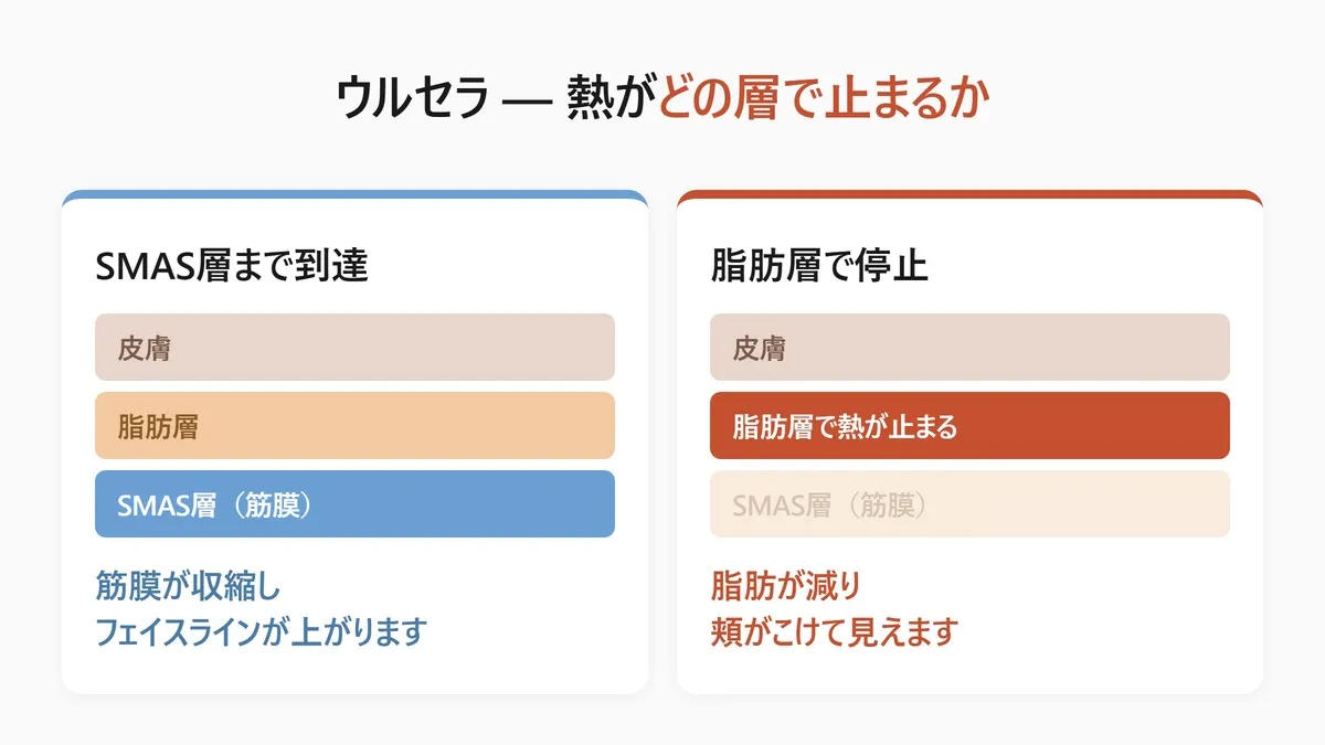 韓国のウルセラ 熱が止まる層で分かれる結果