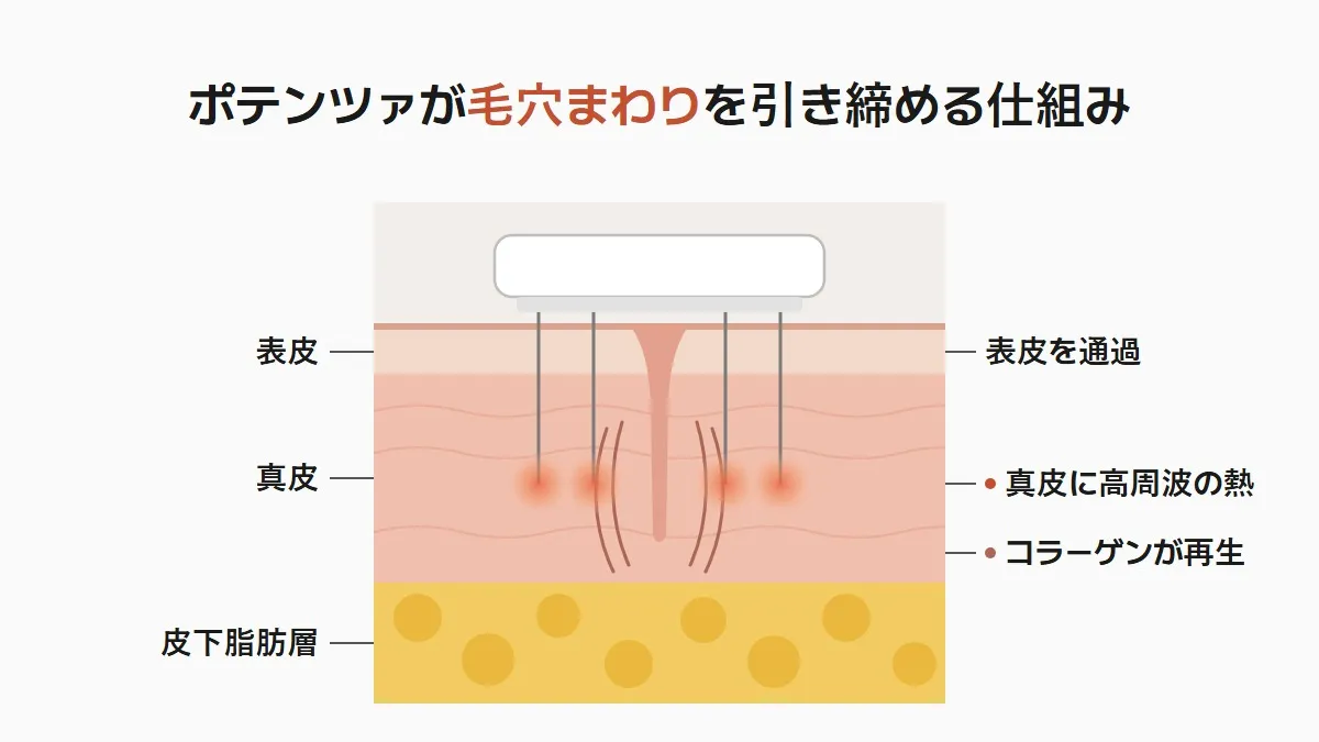 韓国のポテンツァ ニードルRFが毛穴を引き締める仕組み