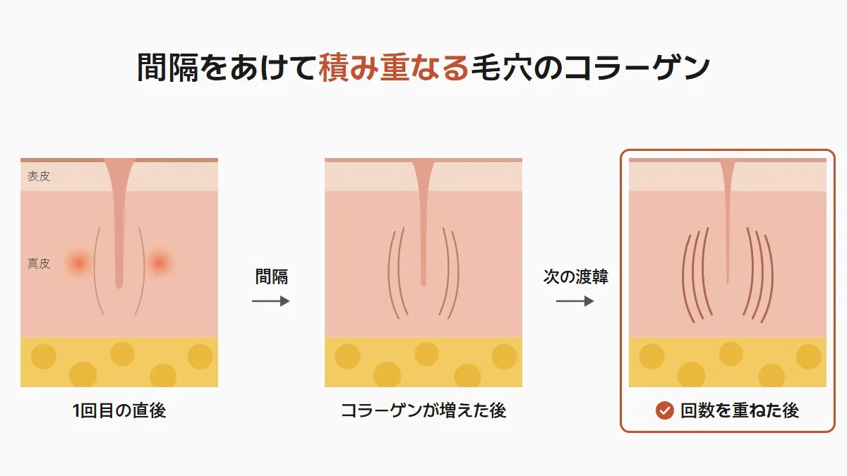 韓国のポテンツァ 間隔で積み重なる毛穴のコラーゲン