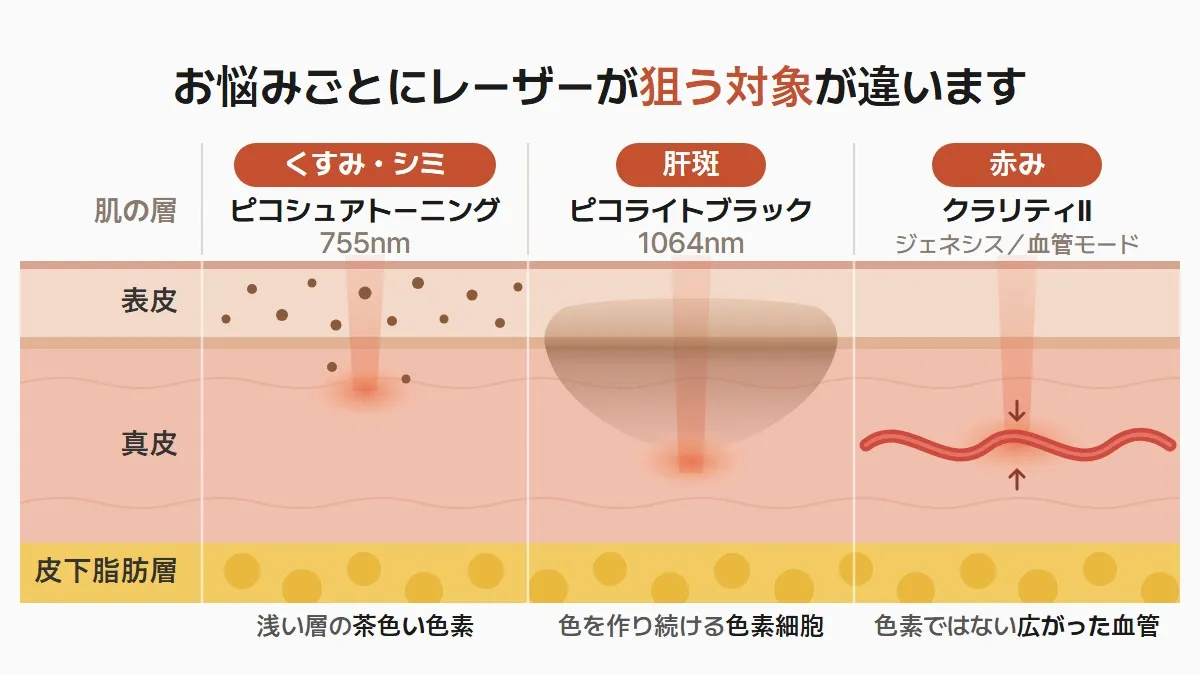 韓国の美肌治療、美白とトーンアップはどのレーザーで変わりますか