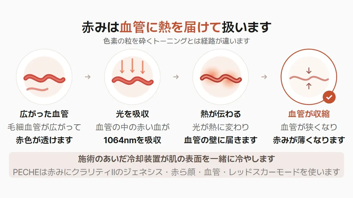 韓国の美肌治療 赤みの血管が収縮する流れ