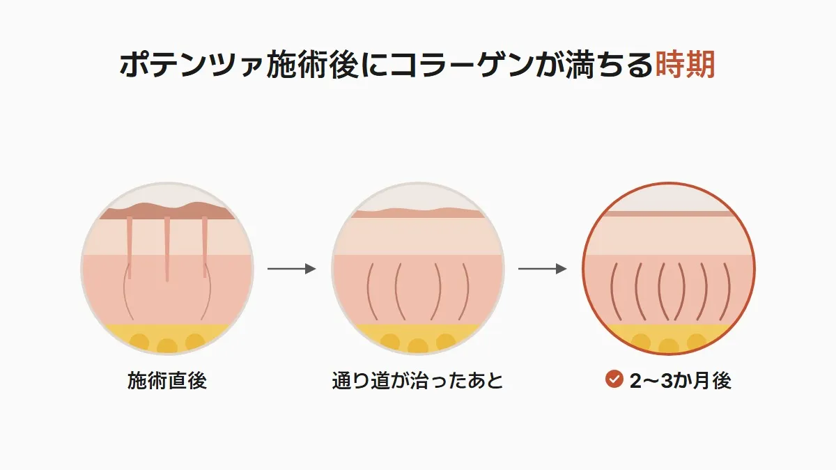 韓国のポテンツァ 施術後にコラーゲンが満ちる時期