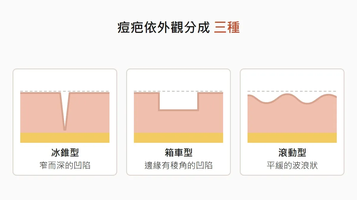 韓國痘疤的冰錐型箱車型滾動型外觀