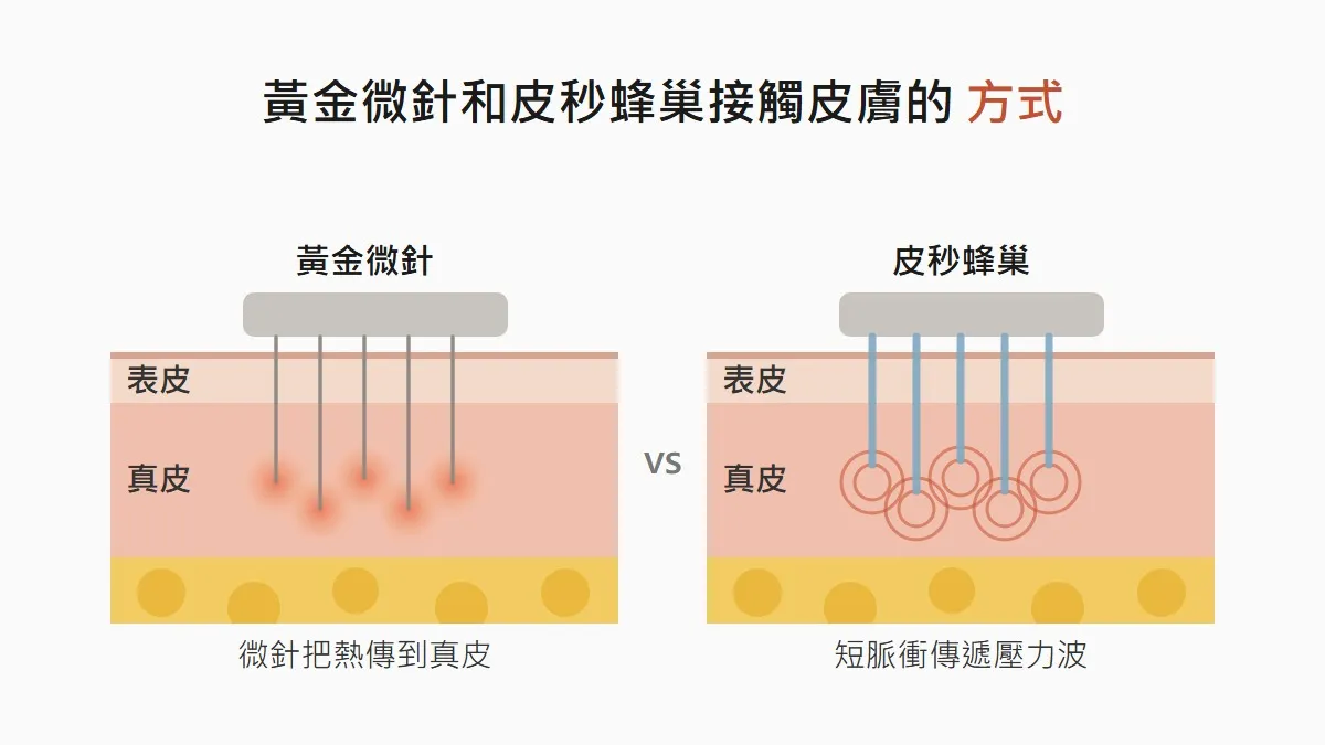 韓國的黃金微針，依毛孔與痘疤的形狀選擇會不同