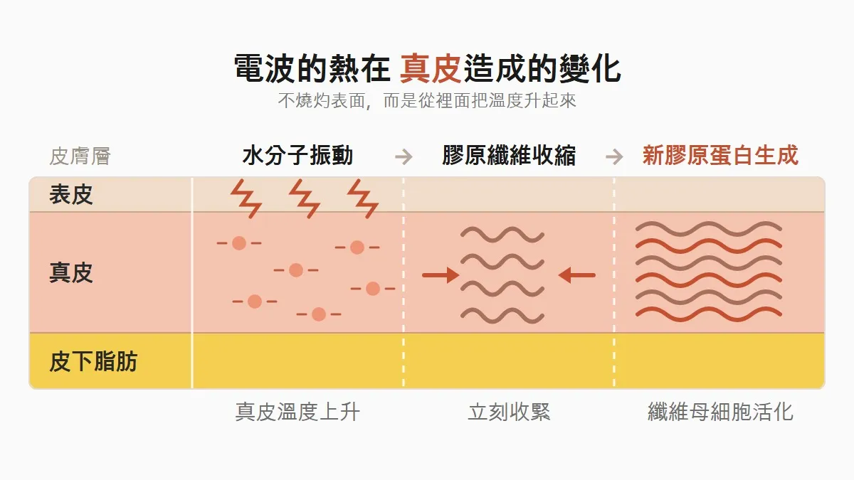韓國電波的熱在真皮造成的變化