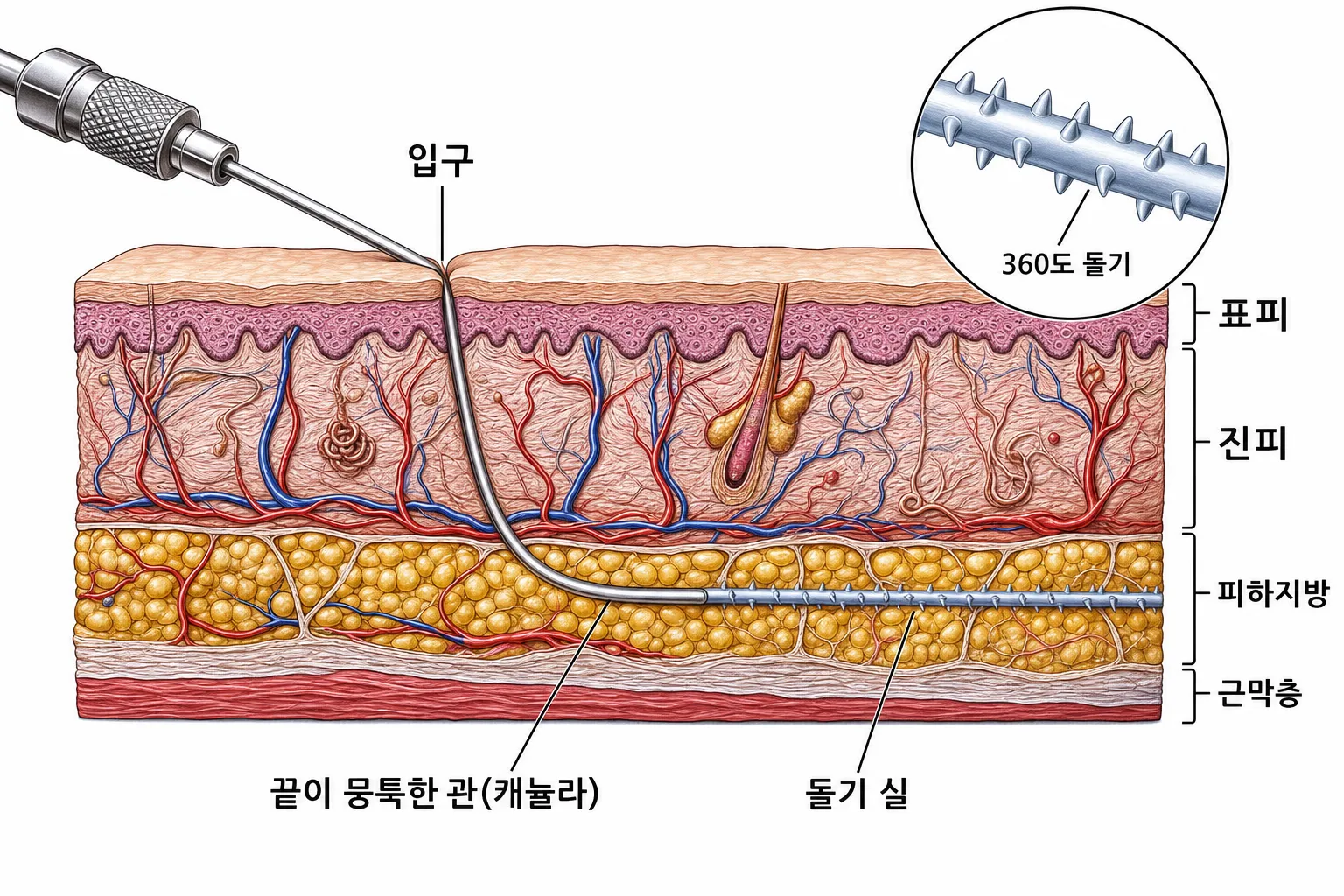 바늘 자국 크기의 입구로 끝이 뭉툭한 관(캐뉼라)이 들어가 피부밑 지방층을 수평으로 지나고, 그 길을 따라 돌기 실이 놓이는 피부 단면 도해 — 확대 원 안에 360도로 돌기가 난 실